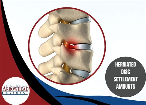 After paying medical providers, the clients net recovery was 9,648. . Herniated disc settlement texas